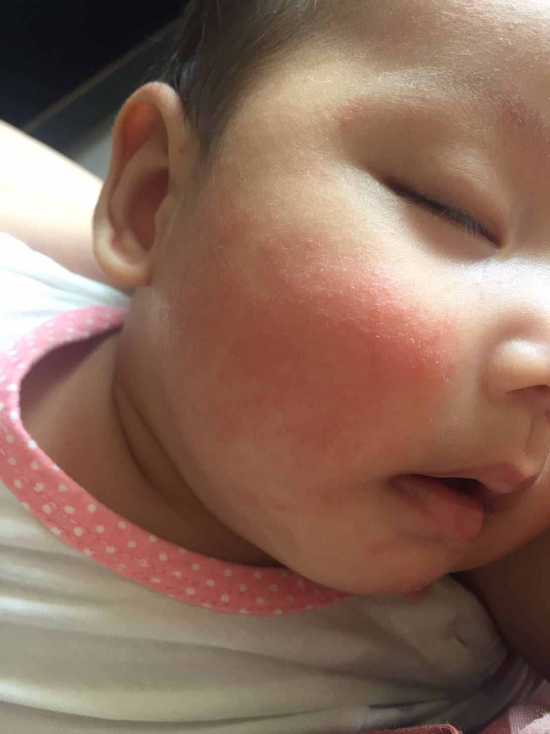 婴儿湿疹有哪些症状 （新生儿湿疹症状）