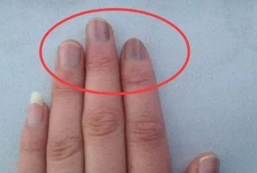 指甲上出现竖纹，只是因为缺钙吗？或许是身体发出的求救信号
