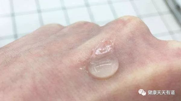 手脚上总起“小水泡”，一抓还很痒还会流出些液体，是怎么回事？