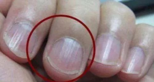 指甲上出现竖纹，只是因为缺钙吗？或许是身体发出的求救信号