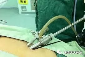 腹腔镜穿刺孔和传统手术切口有什么区别？