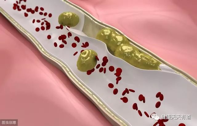 血栓的天敌是什么？医生一次告诉您，忠言逆耳，从不忽悠