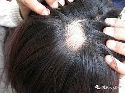 慢性脂溢性脱发的病理过程！