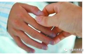 手指甲可以测定一个人的健康状况，你知道指甲发紫是怎么回事？