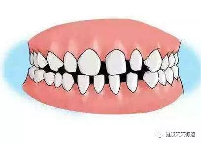 牙齿稀疏是病吗？
