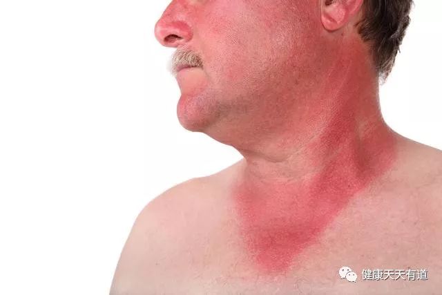 晒个太阳皮肤变红很正常，但出现这种红斑，尽快看医生