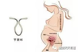 女性的“节育环，相当于长期的刮宫流产术？