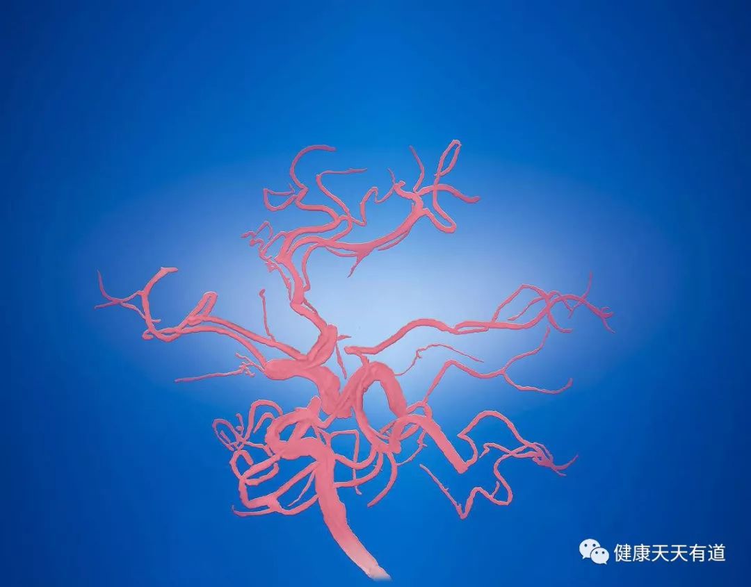 血管狭窄会有四个信号，超过两个提示，提示血栓正在形成！