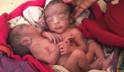 印度女子产下双胞胎连体婴4只手2只脚 孕期做好产检保证优生