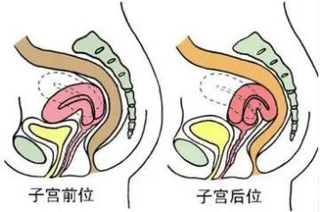 北京医生透露：子宫前位如何提高受孕几率呢？