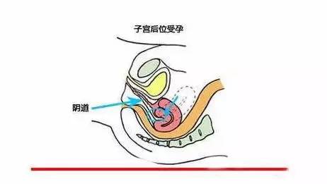 北京医生透露 : 子宫后位如何同房？快速怀孕备孕姿势