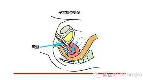 告诉你：几张图揭示子宫后位秘密，子宫后位是怎么引起的？