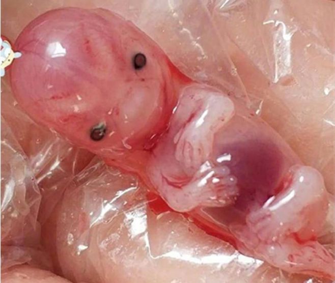 60天胎宝流产出来的模样！网友：一边看，一边流泪，太让人揪心！