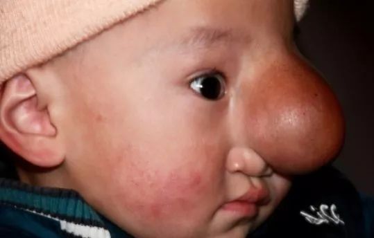 1岁小孩脸上长个大包，手术切除极难，危在旦夕，图3不忍直视
