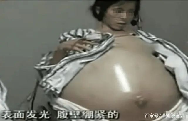 女子为怀孕乱喝偏方的“怪病”腹围高达1米7，医生：得有20个孩子