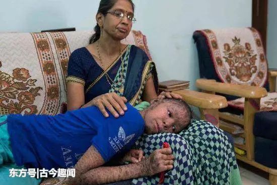 印度一女孩患罕见病，全身鱼鳞，被人称为“蛇女”，白天不敢出门
