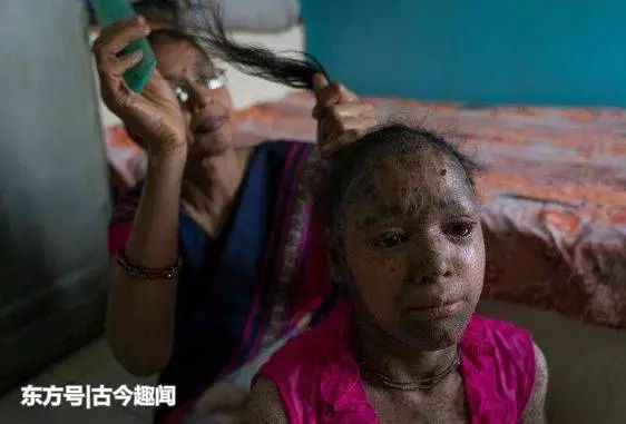 印度一女孩患罕见病，全身鱼鳞，被人称为“蛇女”，白天不敢出门