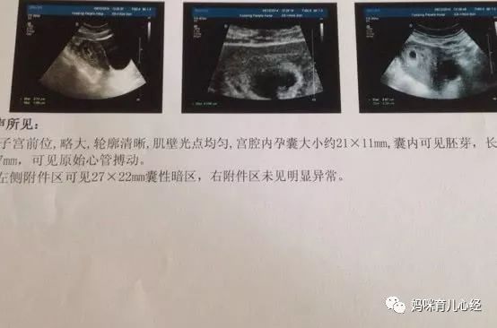 腹中是“女宝”，孕妈可能有这3种特征，不妨来看看