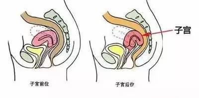 妇科医生：子宫后位如何备孕姿势