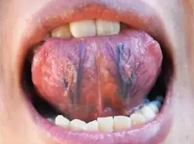 舌下有紫筋，血管危险大！