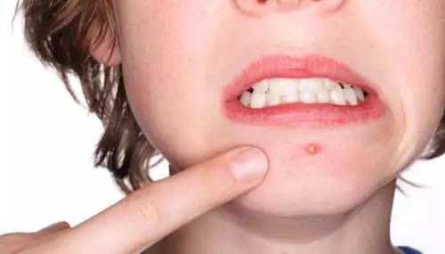 你的下巴为何反复长痘？