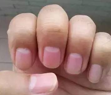指甲的半月痕跟身体的关联
