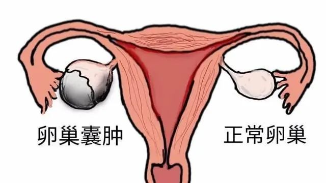 什么是卵巢囊肿？听听医生怎么说..