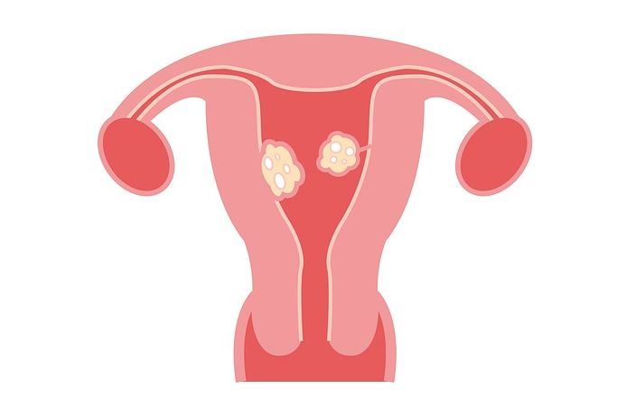 子宫肌瘤是怎么形成的，与遗传有关吗？