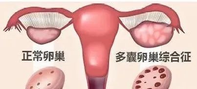 多囊卵巢综合症“囊”为何物？多囊还可以怀孕吗？