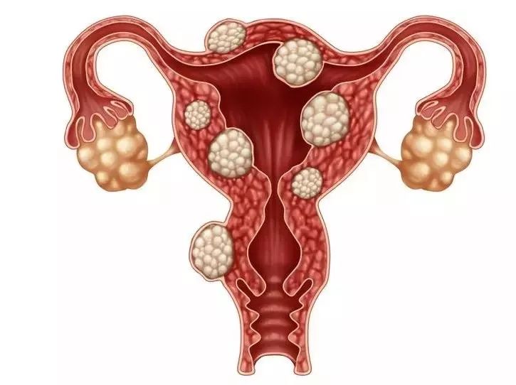 38岁女子体内竟有61个子宫肌瘤！