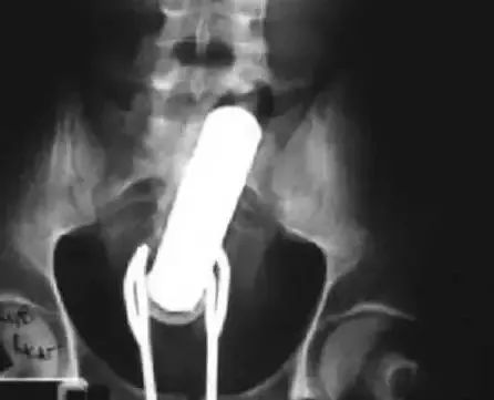 人造假胸在X光透视下，会是什么样子？