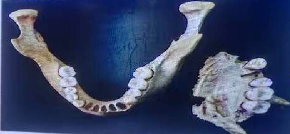 考古学家从曹操墓发现了3颗牙齿，揭开曹操一隐疾！