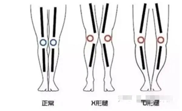 O型腿会遗传吗？父母注意：这几种情况下，腿型会遗传给下一代