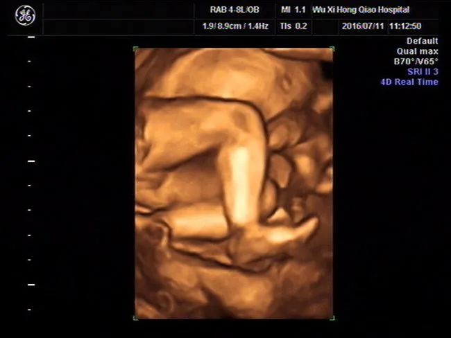 通过四维可以清晰看到的胎儿性别照片，您懂了吗？