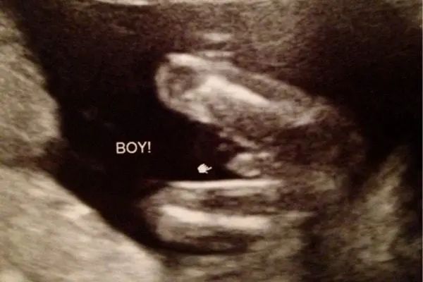 通过四维可以清晰看到的胎儿性别照片，您懂了吗？