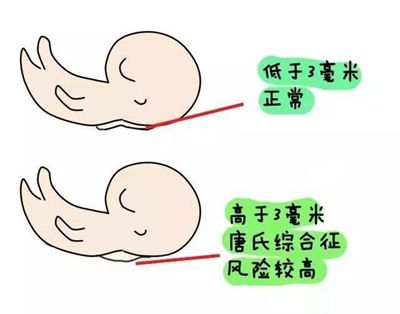 如何知道胎儿畸形？3个症状显示胎儿智力低下，孕妇早知道早治疗