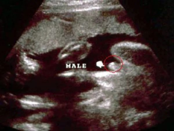 据说这些孕期彩超有明显的男宝特征，您怎么看!