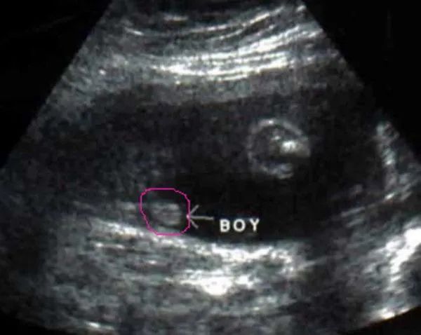据说这些孕期彩超有明显的男宝特征，您怎么看!