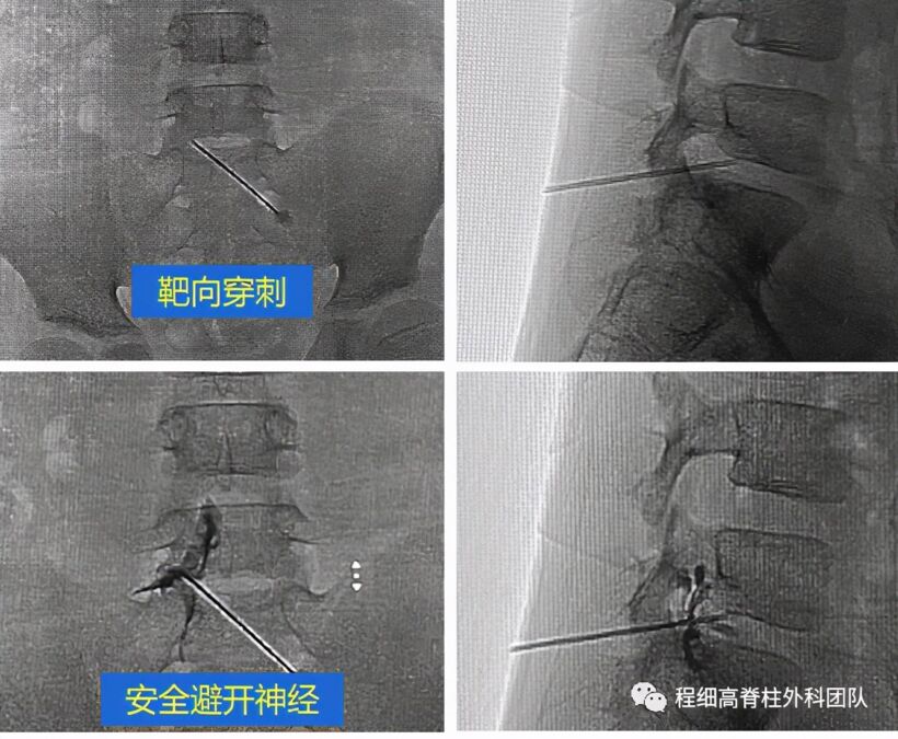 南大二附院程细高脊柱微创外科团队助力12岁跳水运动员重返赛场