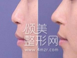 注射隆鼻的价格和假体隆鼻整形有什么区别