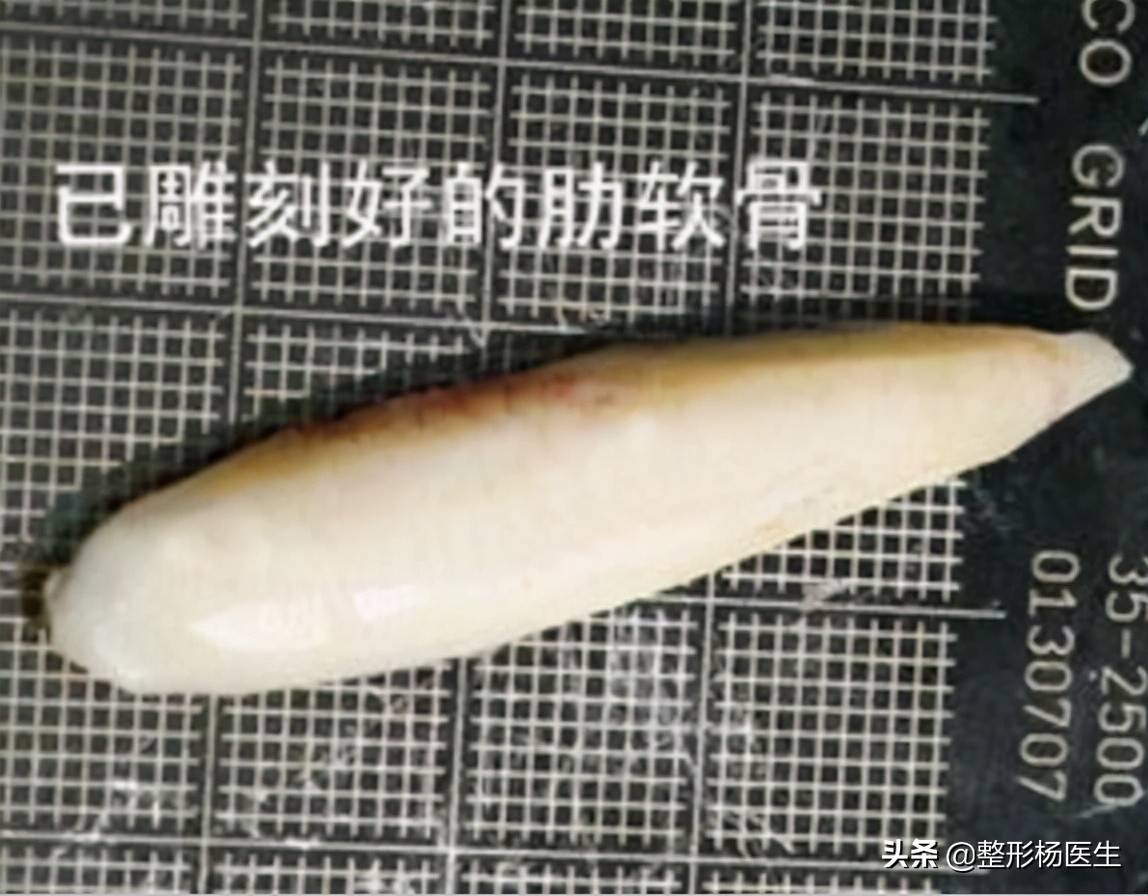 隆鼻材料哪个好？过来人告诉你，只选对的，不选贵的