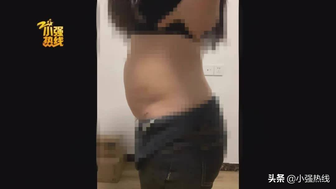 140斤的姑娘抽脂减肥，一次性抽掉4000毫升脂肪