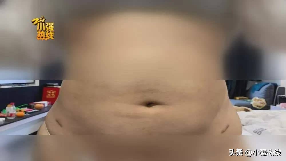 140斤的姑娘抽脂减肥，一次性抽掉4000毫升脂肪