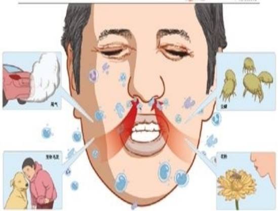 过敏性鼻炎，常用糠酸莫米松鼻喷、孟鲁司特、氯雷他定要注意啥？