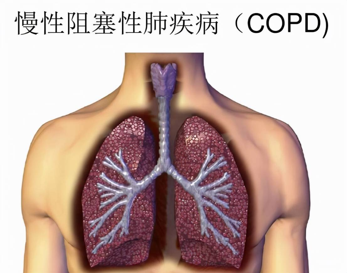 肺部疾病有哪些，又有哪些症状，我们该怎么办？