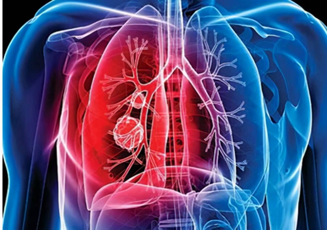 肺部疾病有哪些，又有哪些症状，我们该怎么办？