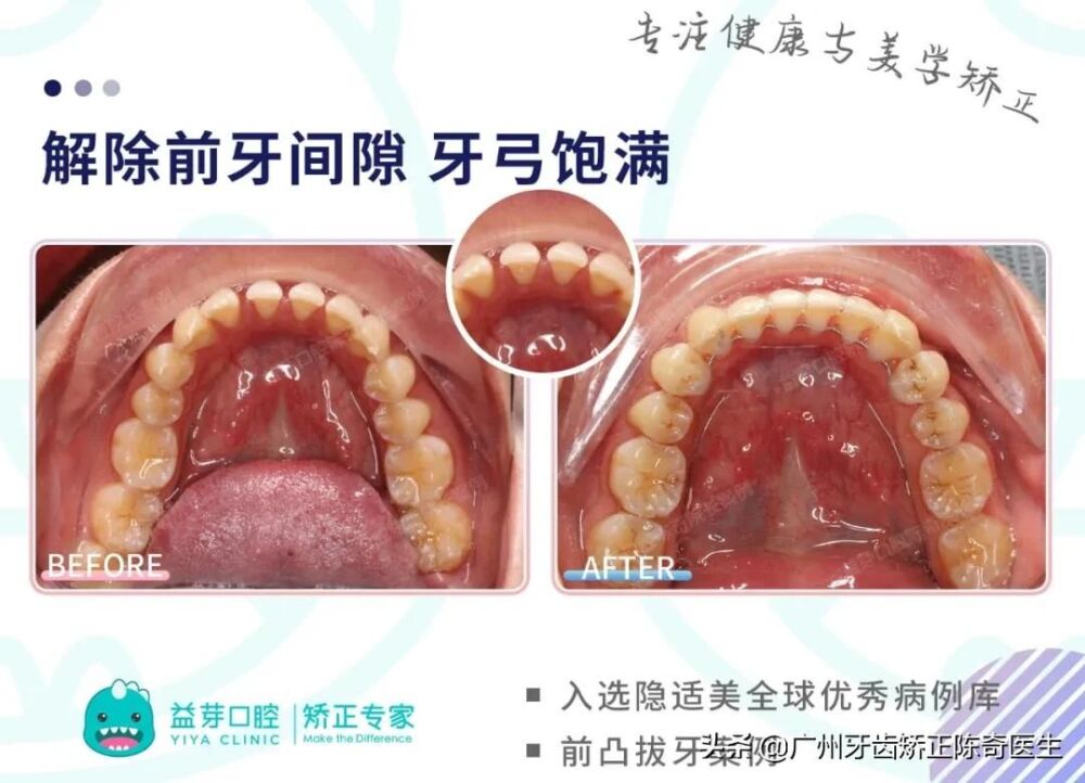 全球优秀案例 | 隐适美拔牙矫正1年半时间解除牙列间隙、改善嘴凸