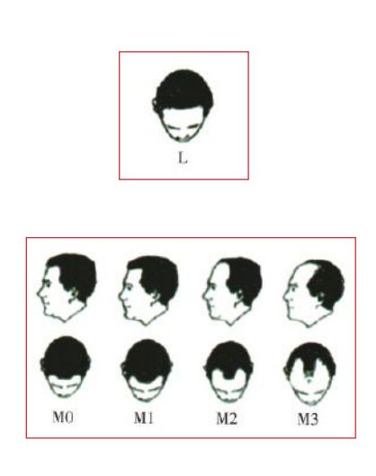 雄激素性脱发的临床分级及鉴别诊断（中）