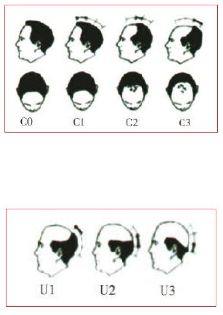 雄激素性脱发的临床分级及鉴别诊断（中）