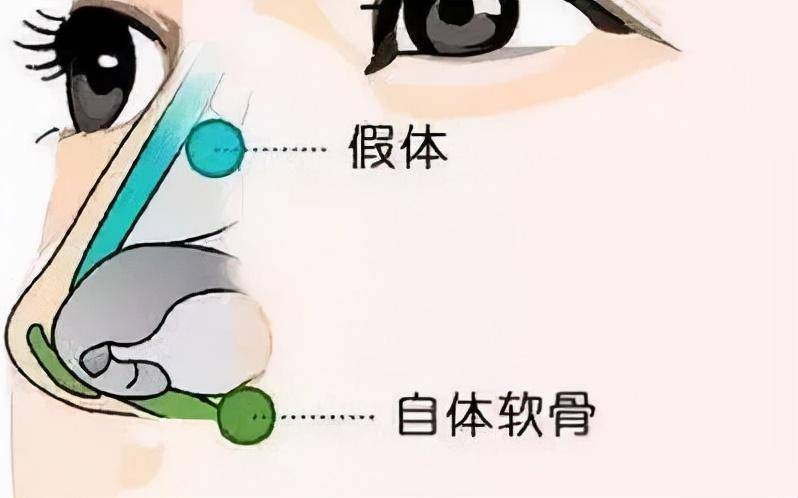 杭州美莱隆鼻科普：想做耳软骨隆鼻的人，你真觉得自己鼻子适合吗
